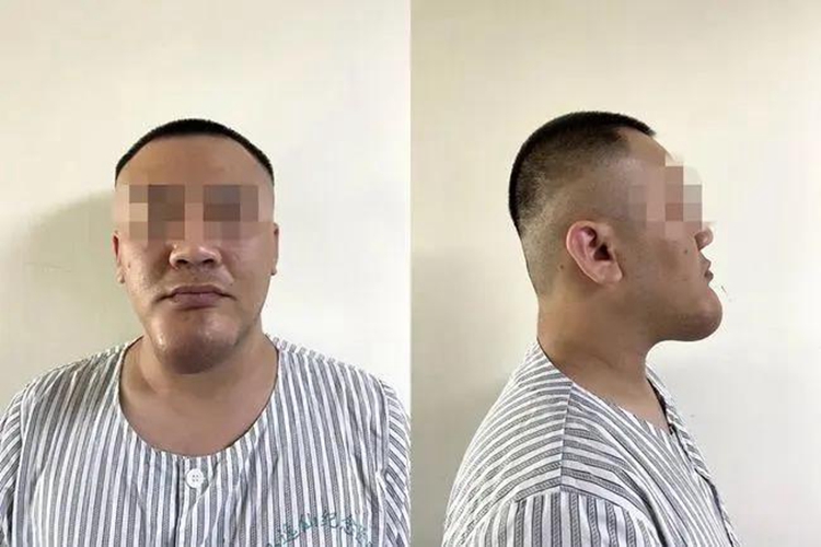 下颌成釉细胞瘤面部畸形图