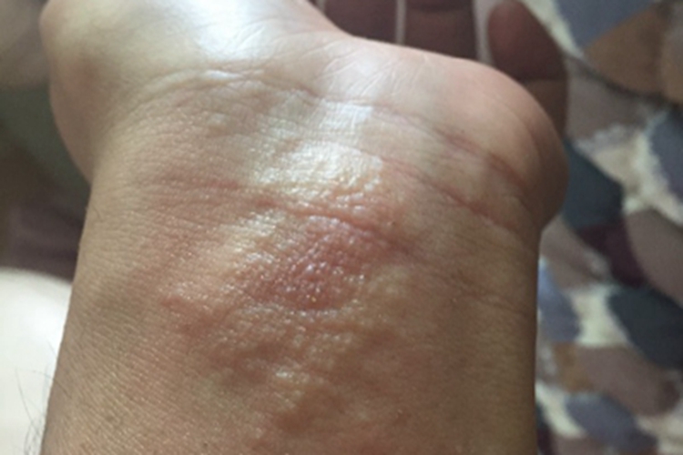 脓疱性细菌疹手腕小水疱图