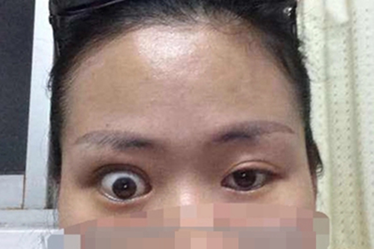 上颌窦癌眼球症状图 上颌窦癌眼球症状图