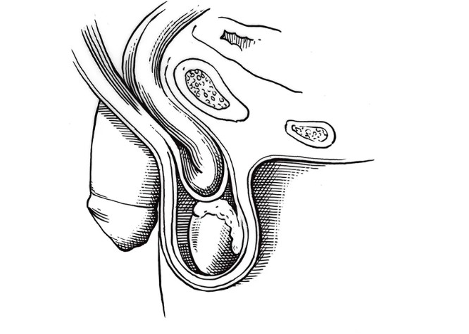 睾丸下垂图片大型图片