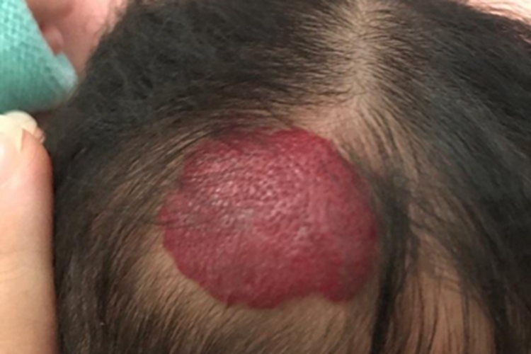 浅表型婴儿血管瘤头皮症状图