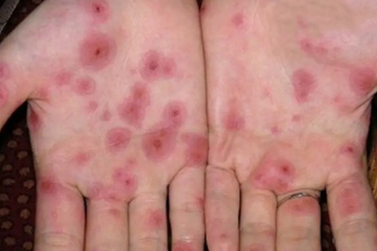 慢性黏膜皮肤念珠菌病血痂图