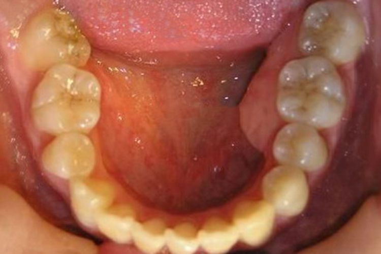 骨隆突图 骨隆突图