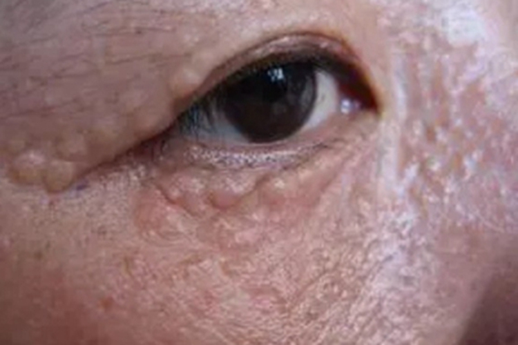 汗管瘤眼周有突起的疙瘩图