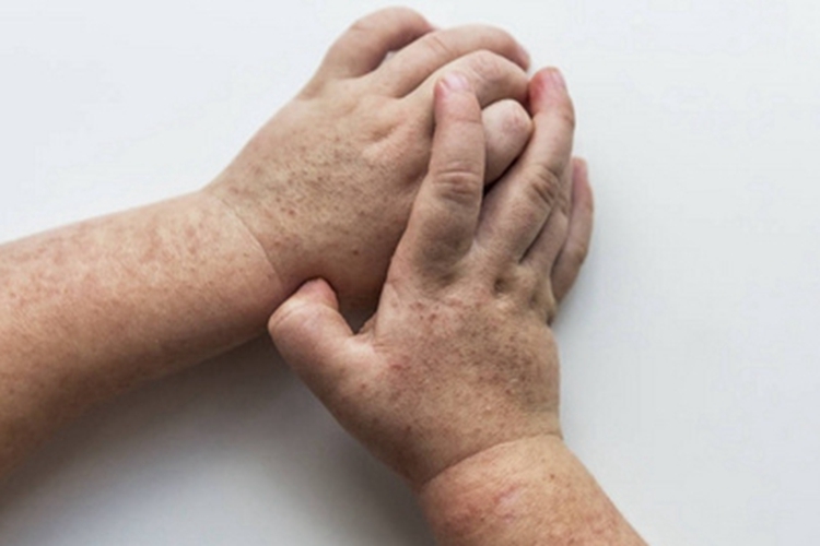 猩红热型药疹手背症状图