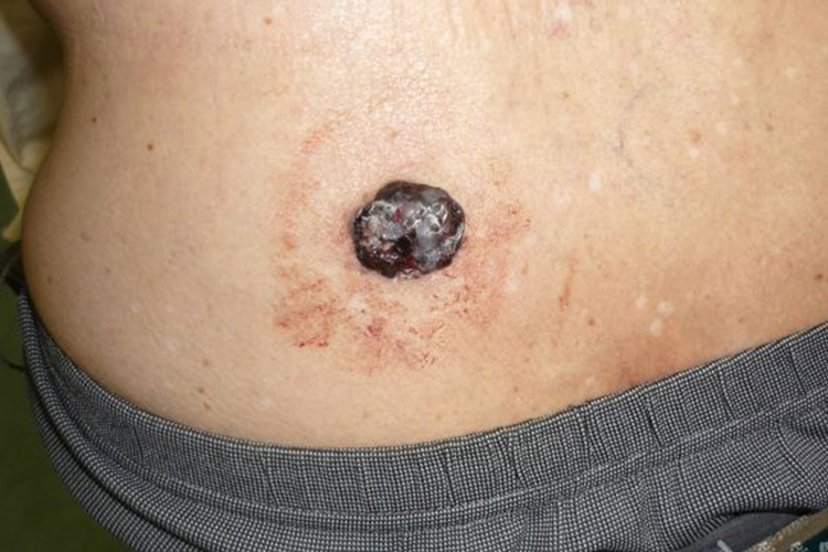 皮肤上表面隆起不平的黑色素瘤图