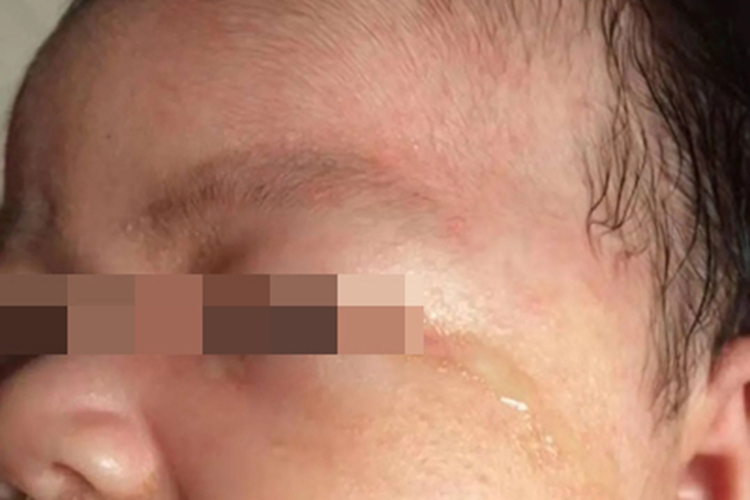 新生儿泪囊炎眼部渗液图