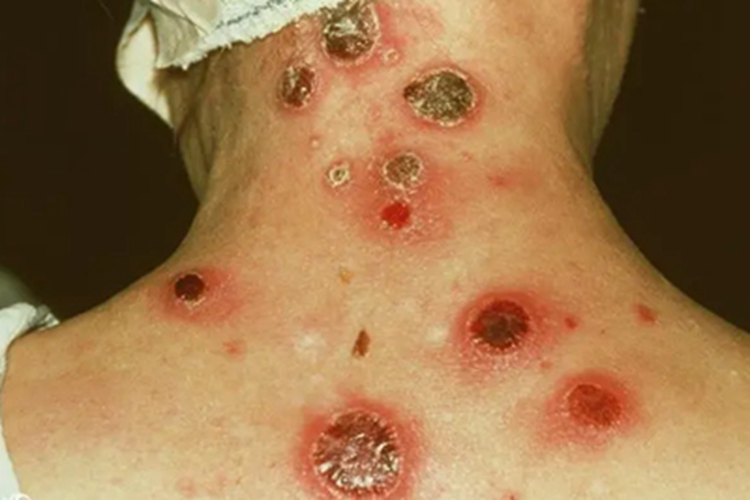 结节性梅毒疹症状图片