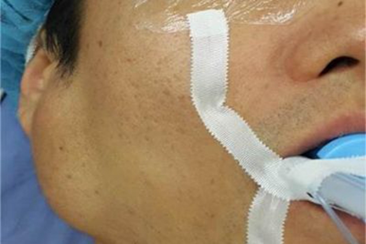 腮腺癌一侧脸肿大变形图