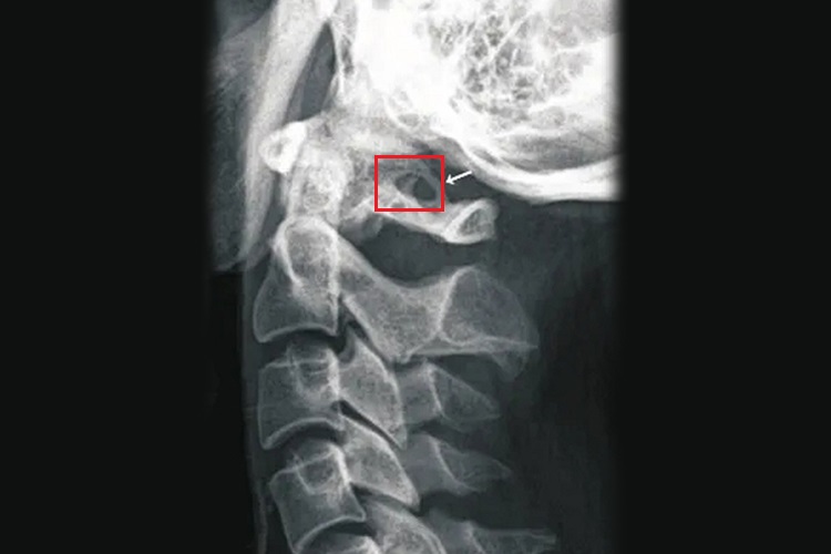 寰椎椎动脉沟环畸形影像图