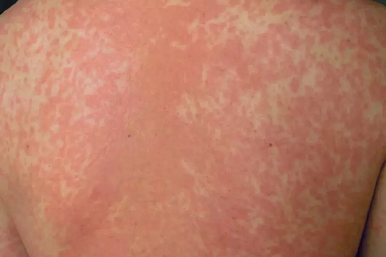 猩红热样皮疹图 猩红热样皮疹图