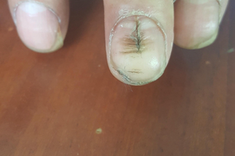指甲纵裂手指甲裂纹图 指甲纵裂手指甲裂纹图