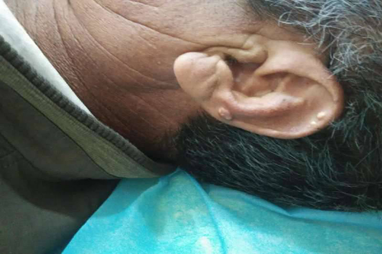 耳轮处痛风石图