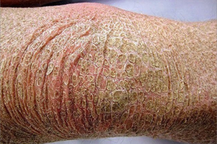 板层状鱼鳞病腿症状图