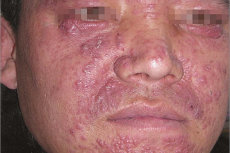 颜面粟粒性狼疮症状图