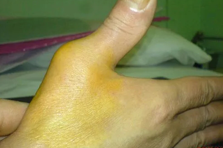 大拇指根部关节脱位图