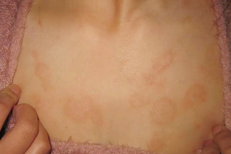 玫瑰糠疹胸前褐色斑图