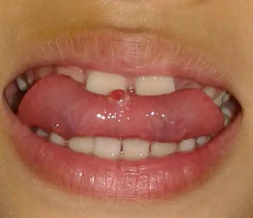 舌头下创伤性血疱图