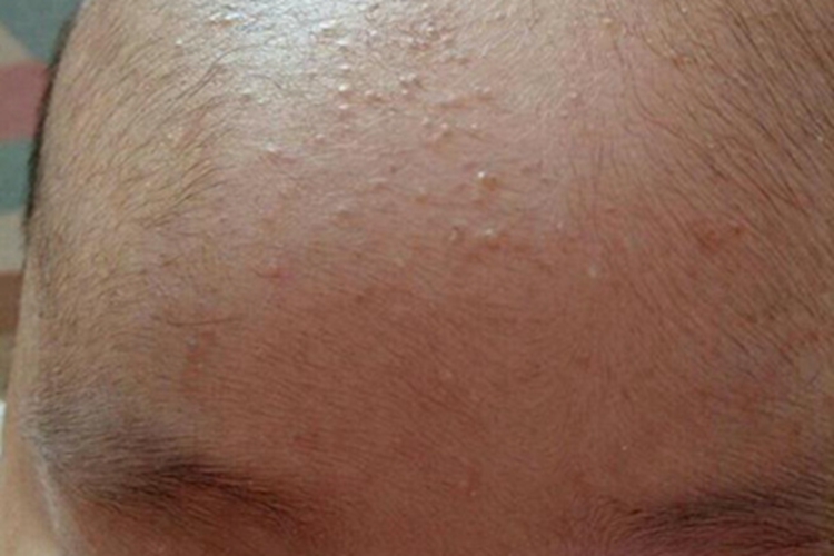 湿疹前额症状图 湿疹前额症状图