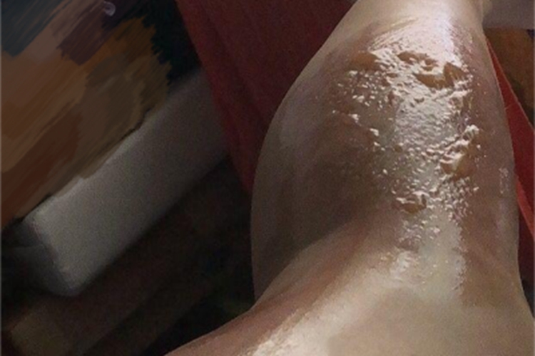 二度烫伤小腿光亮有水疱图