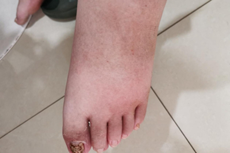 痛风性关节炎脚背肿胀图 痛风性关节炎脚背肿胀图