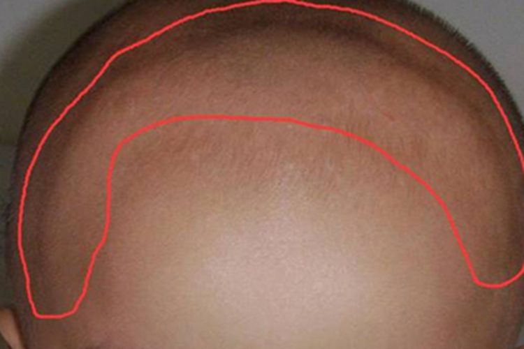 维生素D缺乏性佝偻病头部症状图