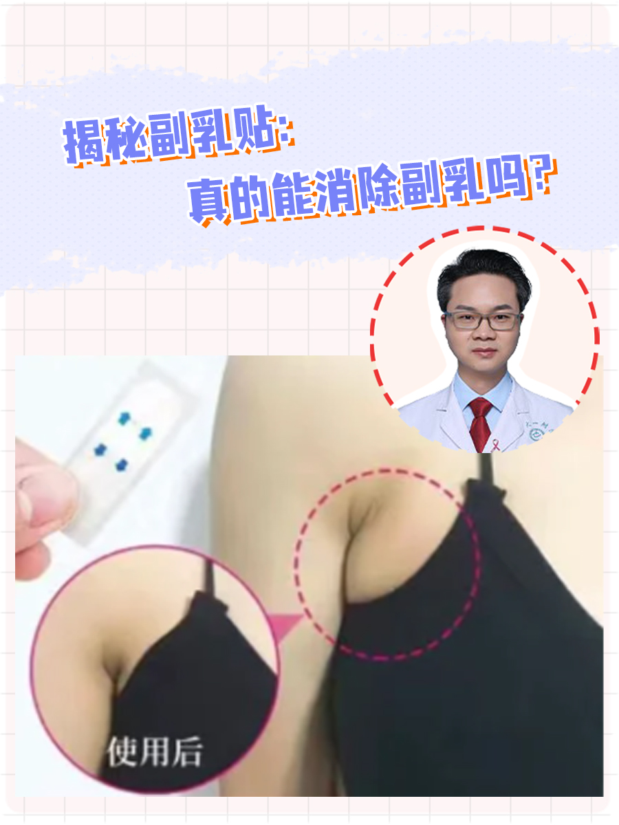 揭秘副乳贴：真的能消除副乳吗？