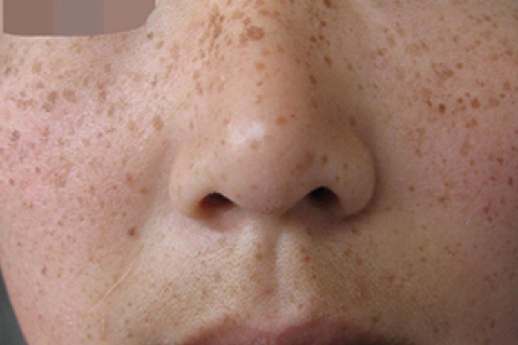 雀斑样痣面部长褐斑图