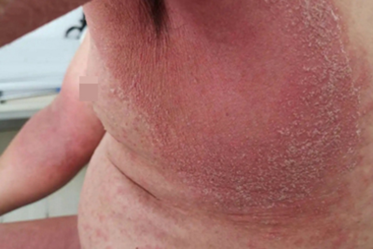 接触传染性脓疱疮腋窝红斑图