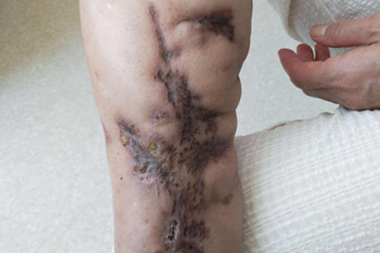 人工性脂膜炎小腿症状图