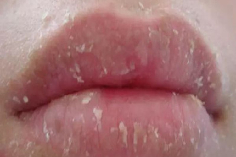 腺性唇炎嘴唇脱皮图