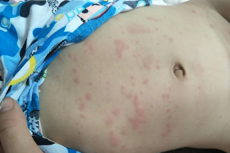 婴儿荨麻疹症状图 婴儿荨麻疹症状图