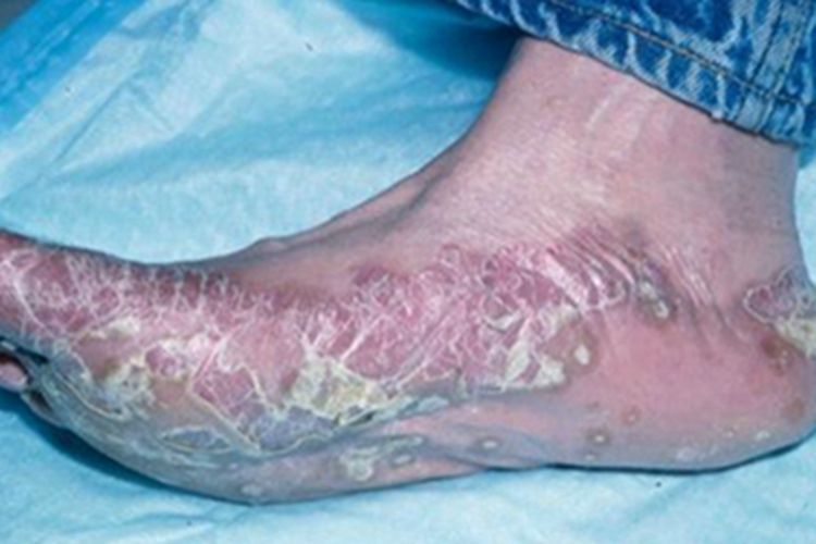 寻常型鱼鳞病脚底脱皮图