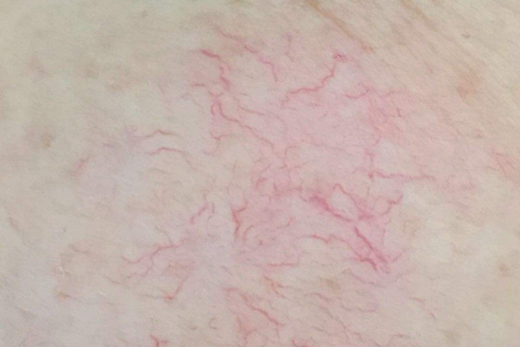 孕期毛细血管扩张图