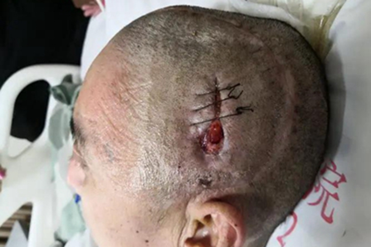 开放性颅脑损伤症状图