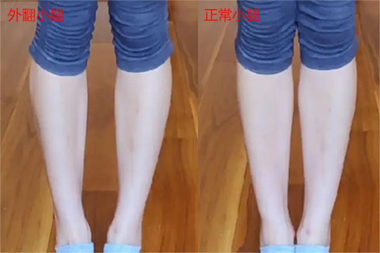 小腿外翻对比图 小腿外翻对比图