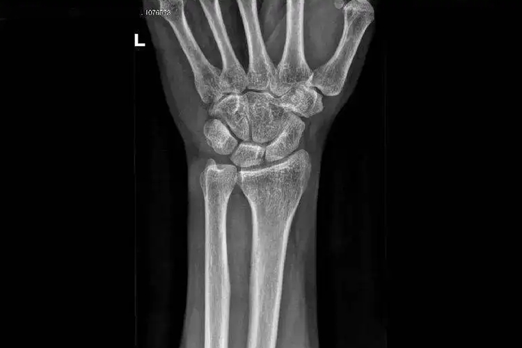 正常的手腕骨骼X光图