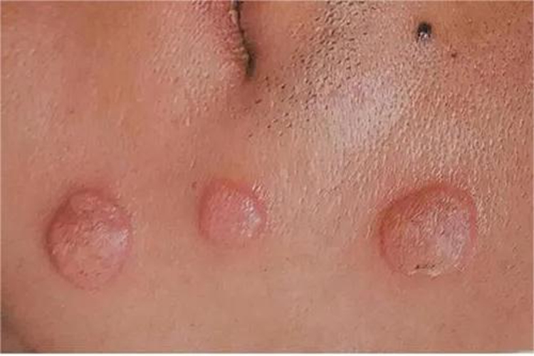 男性二期梅毒面部症状图 男性二期梅毒面部症状图