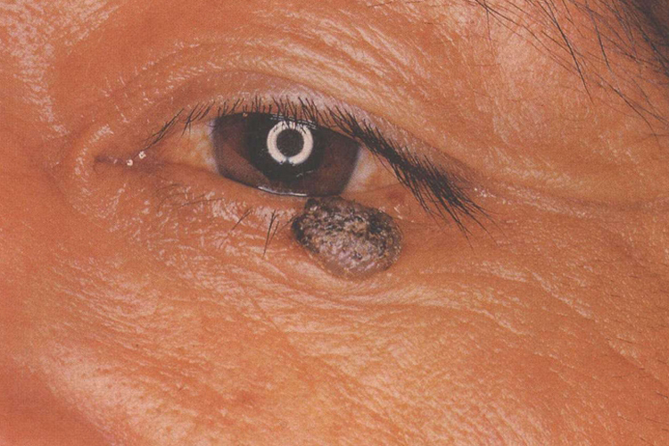 眼睑色素痣图 眼睑色素痣图