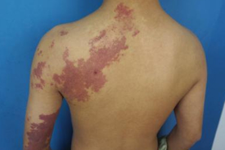 鲜红斑痣背部症状图