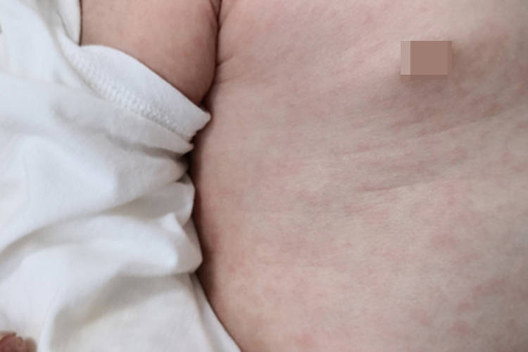 幼儿急疹肚子上起红疹图