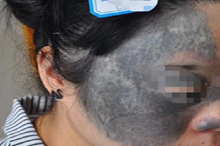 太田痣半边脸都是青灰色斑图