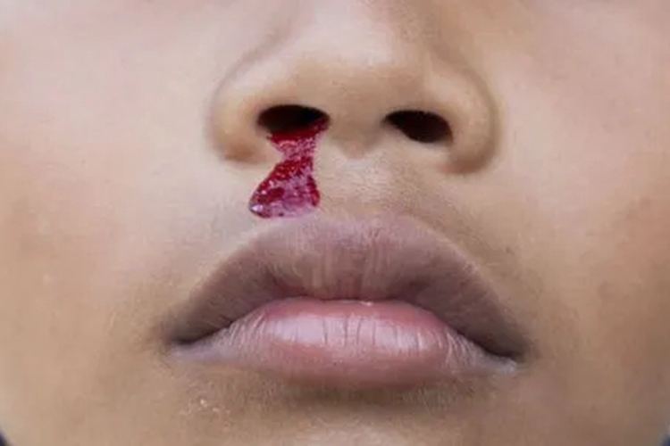 上颌窦癌流鼻血图