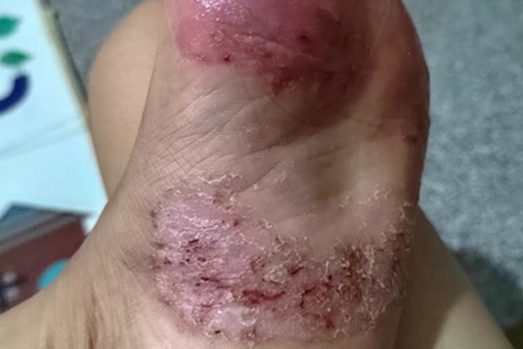 湿疹脚底红肿图