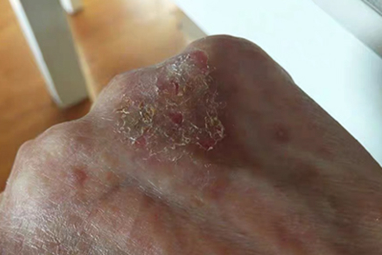 亚急性湿疹黄痂图