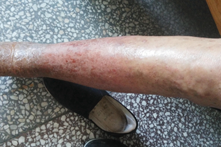 全身性瘙痒症皲裂图