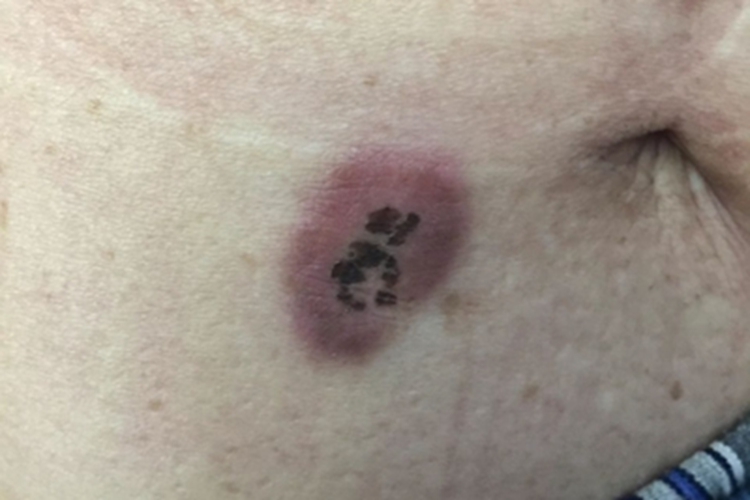 皮下型环状肉芽肿黑痂图