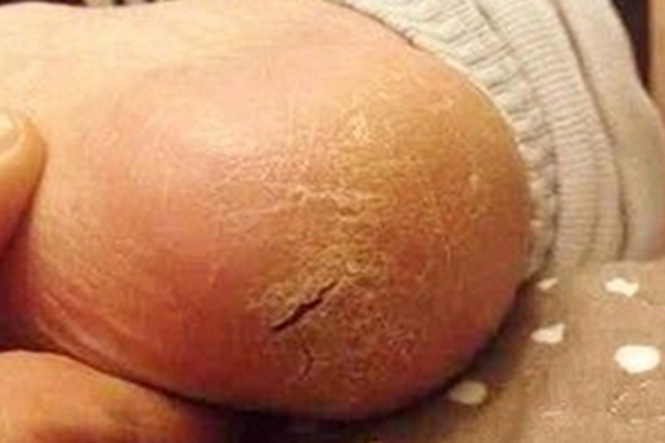 干燥病脚后跟裂了脱皮图 干燥病脚后跟裂了脱皮图