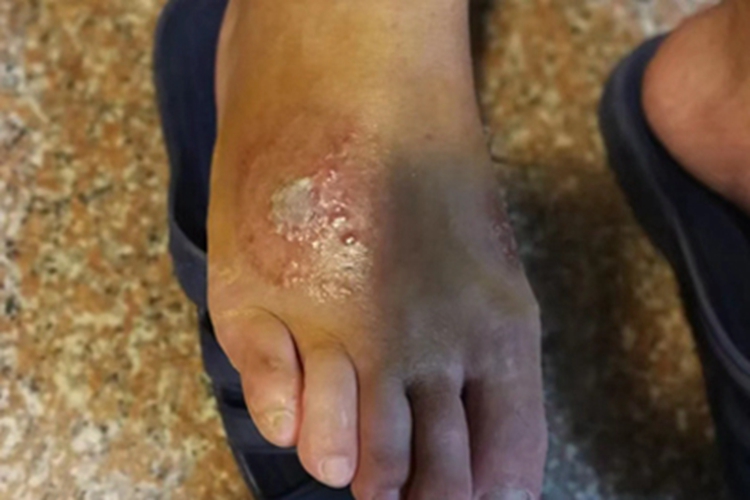 急性湿疹脚背红斑破溃图