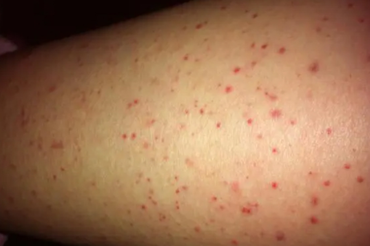 白血病腿上的红点图片